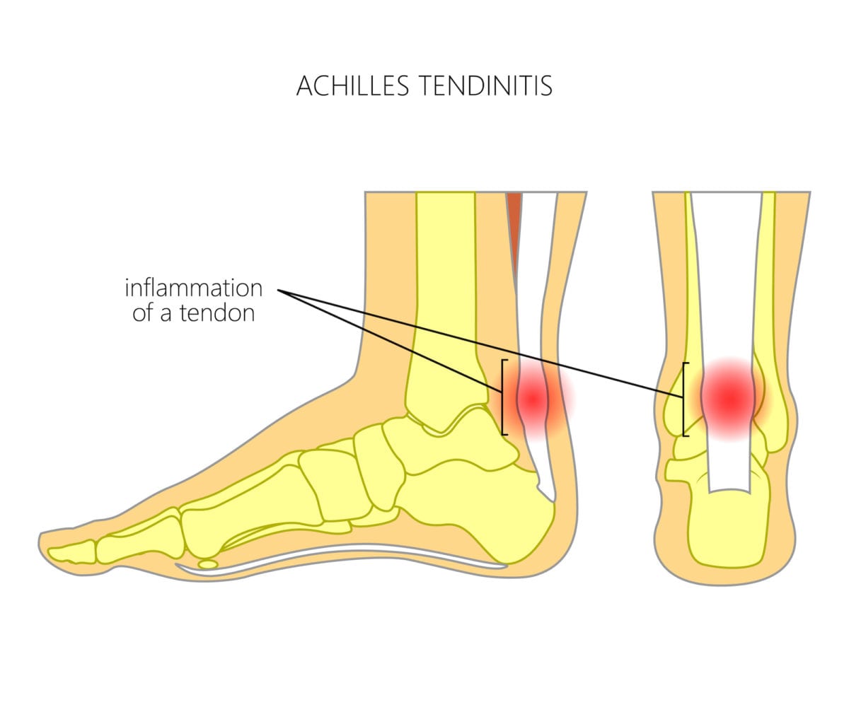 Swollen Feet? Read about 8 Medical Conditions That Can Cause Feet to Swell Up | When people think of swollen feet, most consider the most common causes for the symptom: pregnancy, injury, or a job that requires a lot of walking. But many get swollen feet when these things aren’t the case. In those situations, what’s the cause?