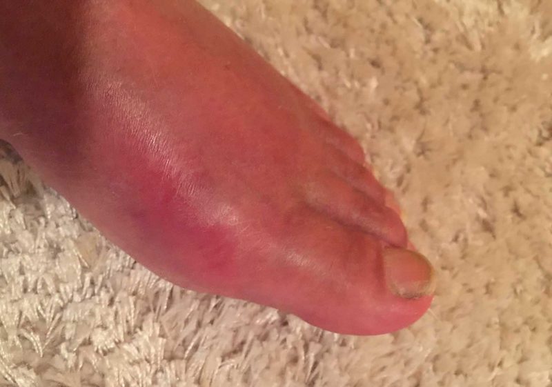 Foot with gout