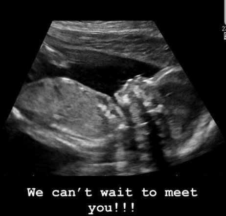 Sonogram of Tori Roloff daughter