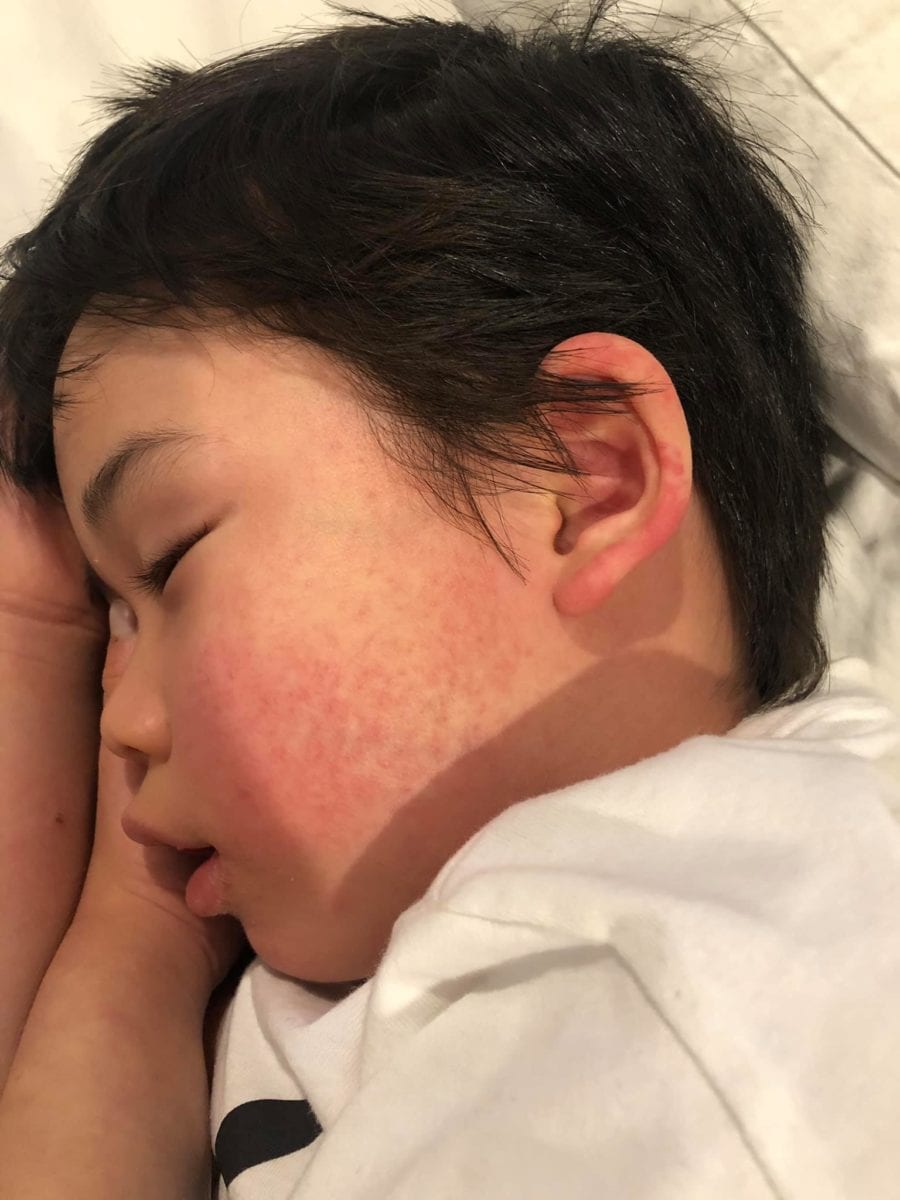 Mom Shares Scary Viral Post About Her Son Having Sepsis as a Warning to Other Parents | "Jarrod developed a fever again and this time with a rash on his face that went white when we pressed it. Home doctor checked and he said it was a viral fever and asked us to give him panadol and neurofen."