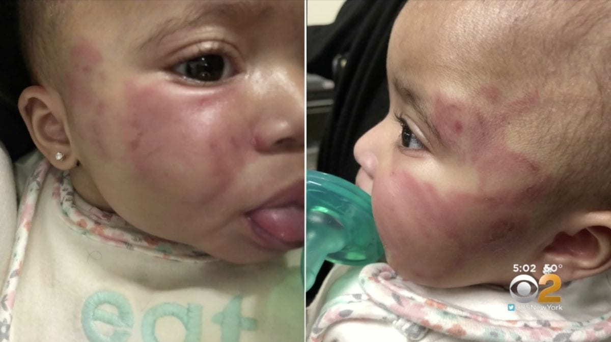 Unlicensed New Jersey Daycare Gets Shut Down After Baby Is Found With Bite Marks on Stomach and Bruises on Her Face