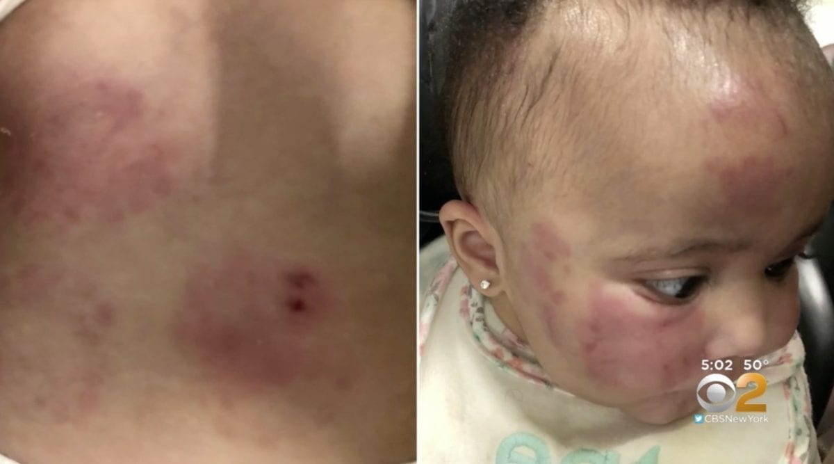 Unlicensed New Jersey Daycare Gets Shut Down After Baby Is Found With Bite Marks on Stomach and Bruises on Her Face