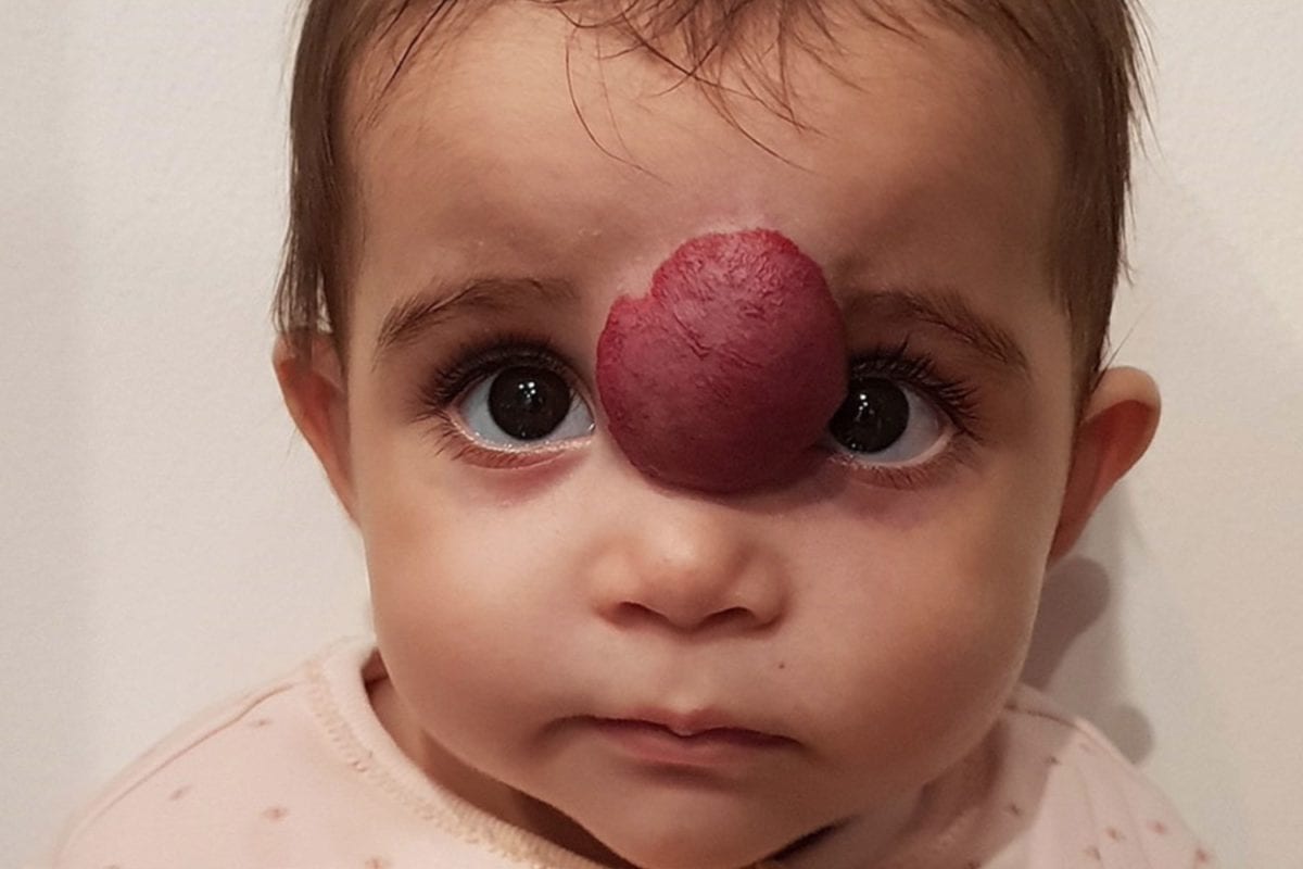 Baby Has Growth Removed From Her Face Just Before Her First Birthday, Now Her Parents Want to Share Her Story for Others