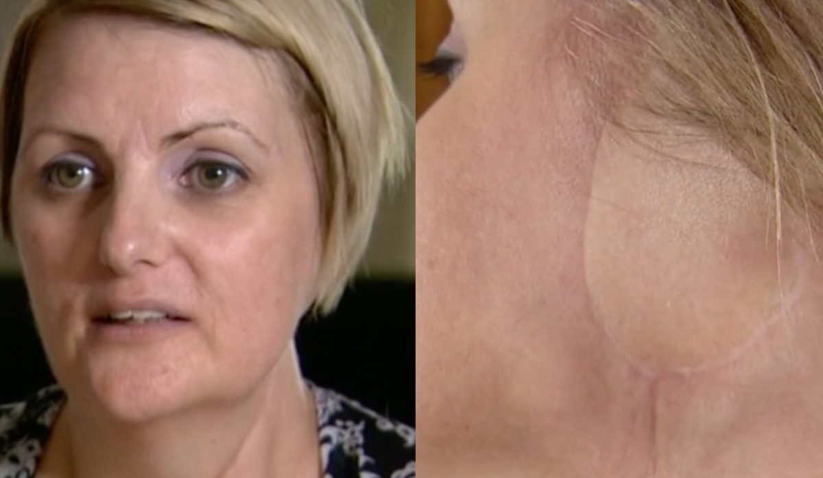 Mom Shares Story After Ear Is Amputated Due to Tanning Addiction