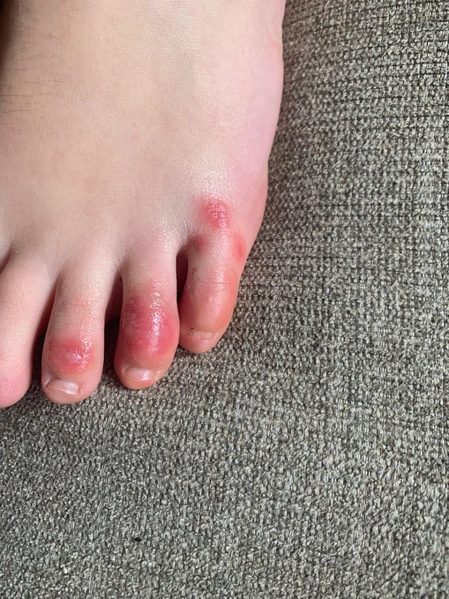 Doctors Say 'COVID Toes' May Potentially Be an Early Symptom for Young People With the Virus | COVID toes “is a manifestation that occurs early on in the disease, meaning you have this first, then you progress."