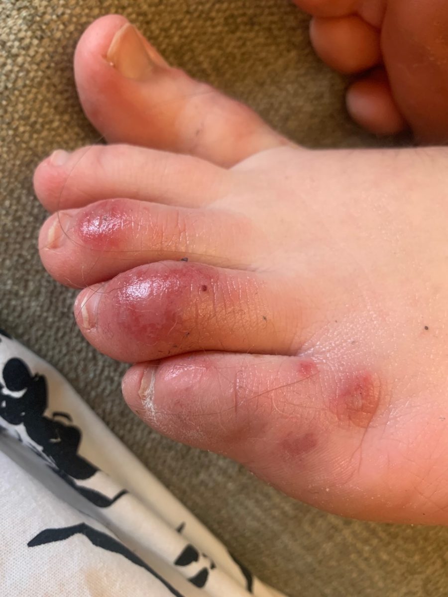 Doctors Say 'COVID Toes' May Potentially Be an Early Symptom for Young People With the Virus | COVID toes “is a manifestation that occurs early on in the disease, meaning you have this first, then you progress."