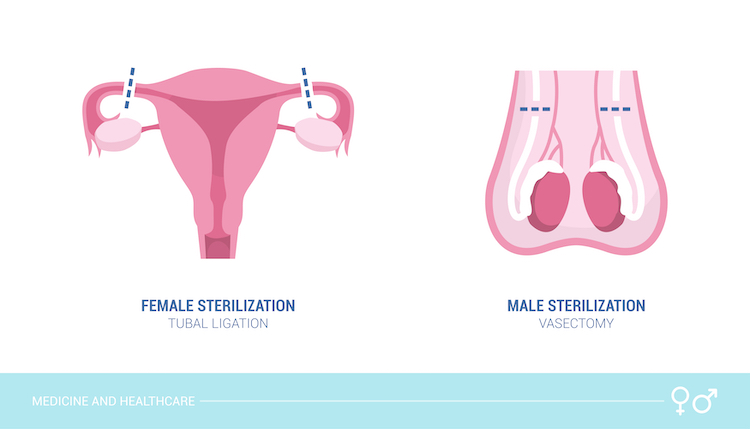 Tubal Ligation vs. Vasectomy: Which Is the Better Option?