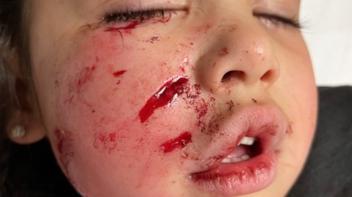 Unprovoked Pit Bull Mauls 3-Year-Old's Face At Restaurant