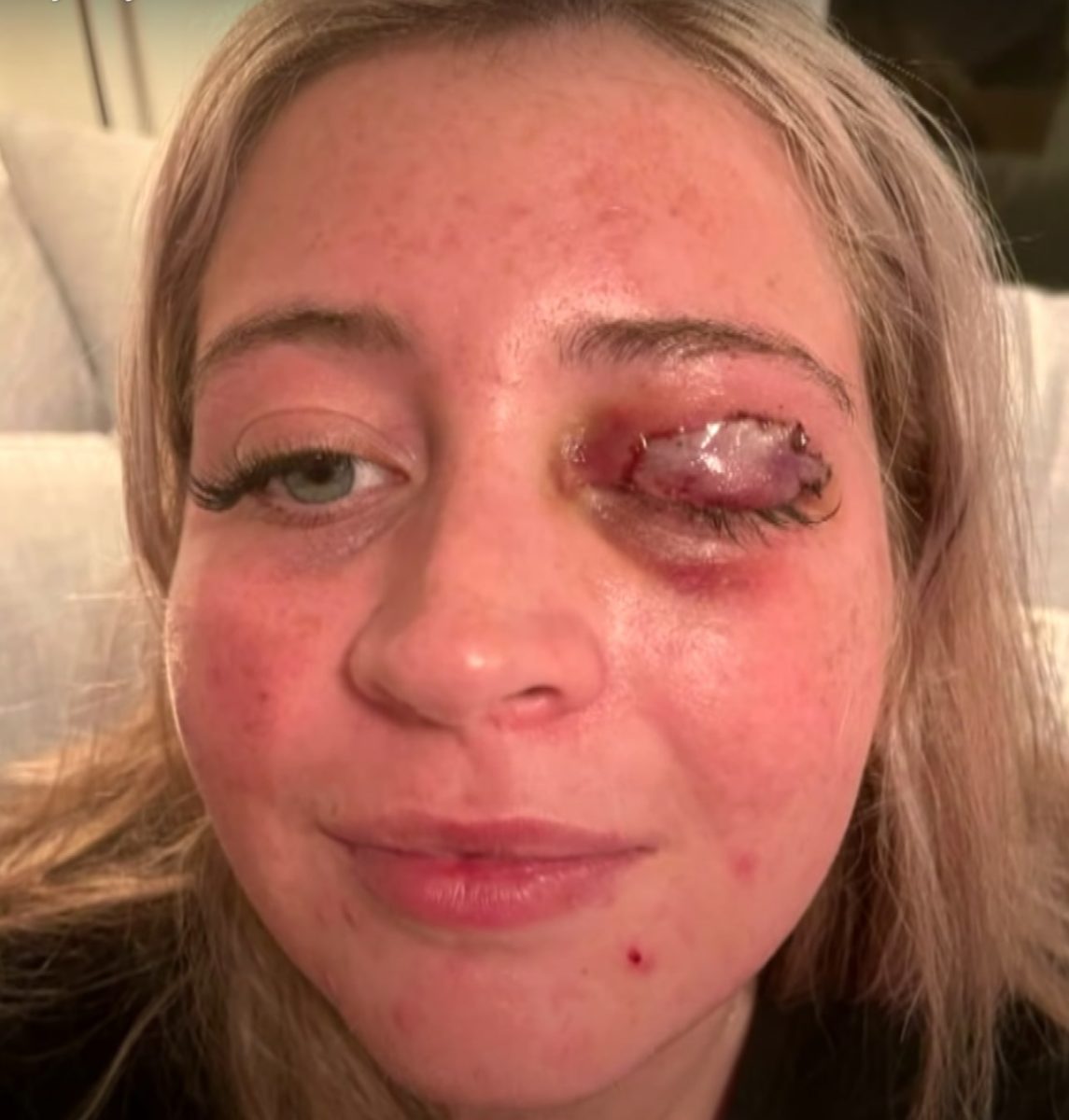 23-Year-Old Woman Gets Eyelid Ripped Off By Her Lash Technician's Chihuahua