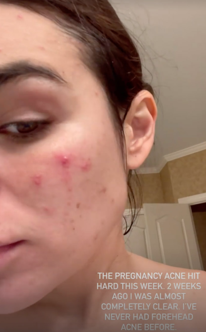 Pregnant Ashley Iaconetti Floored By Pregnancy Acne