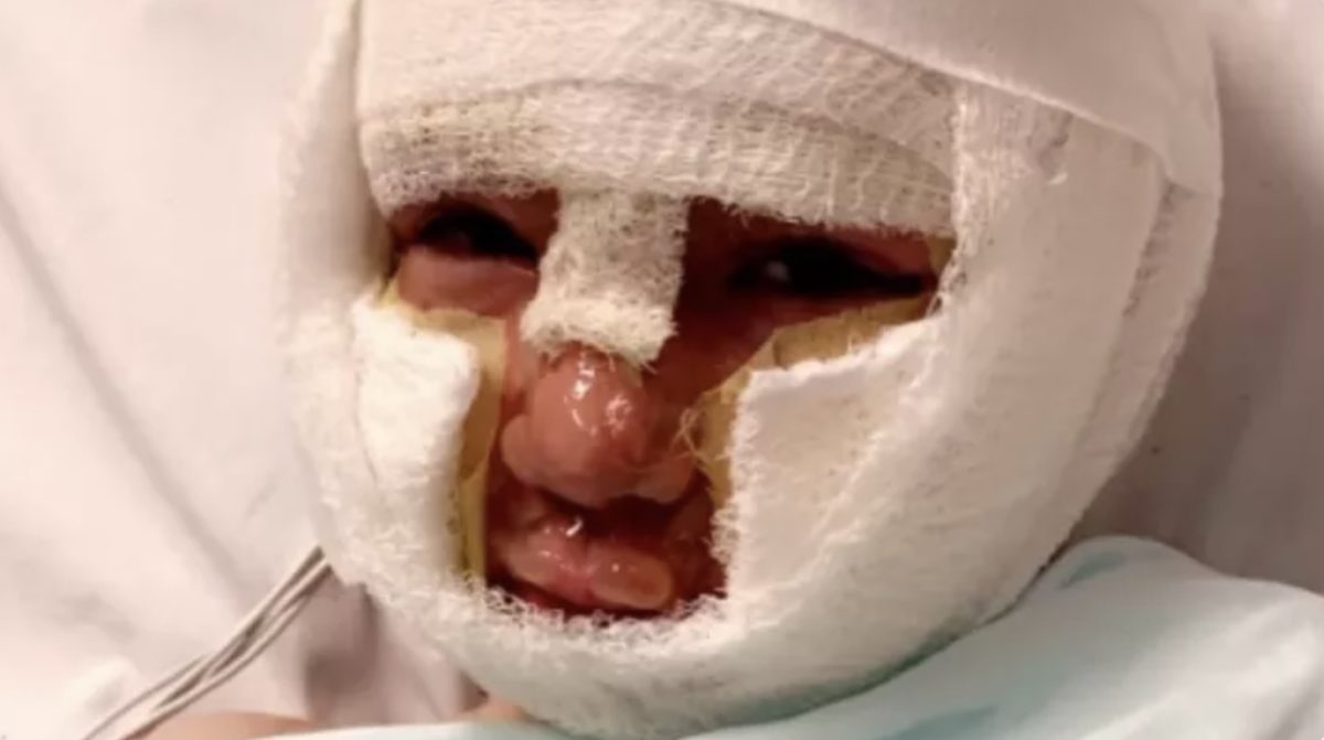 6-Year-Old Boy Suffers Third-Degree Burns After Bully Threw Fireball at His Face