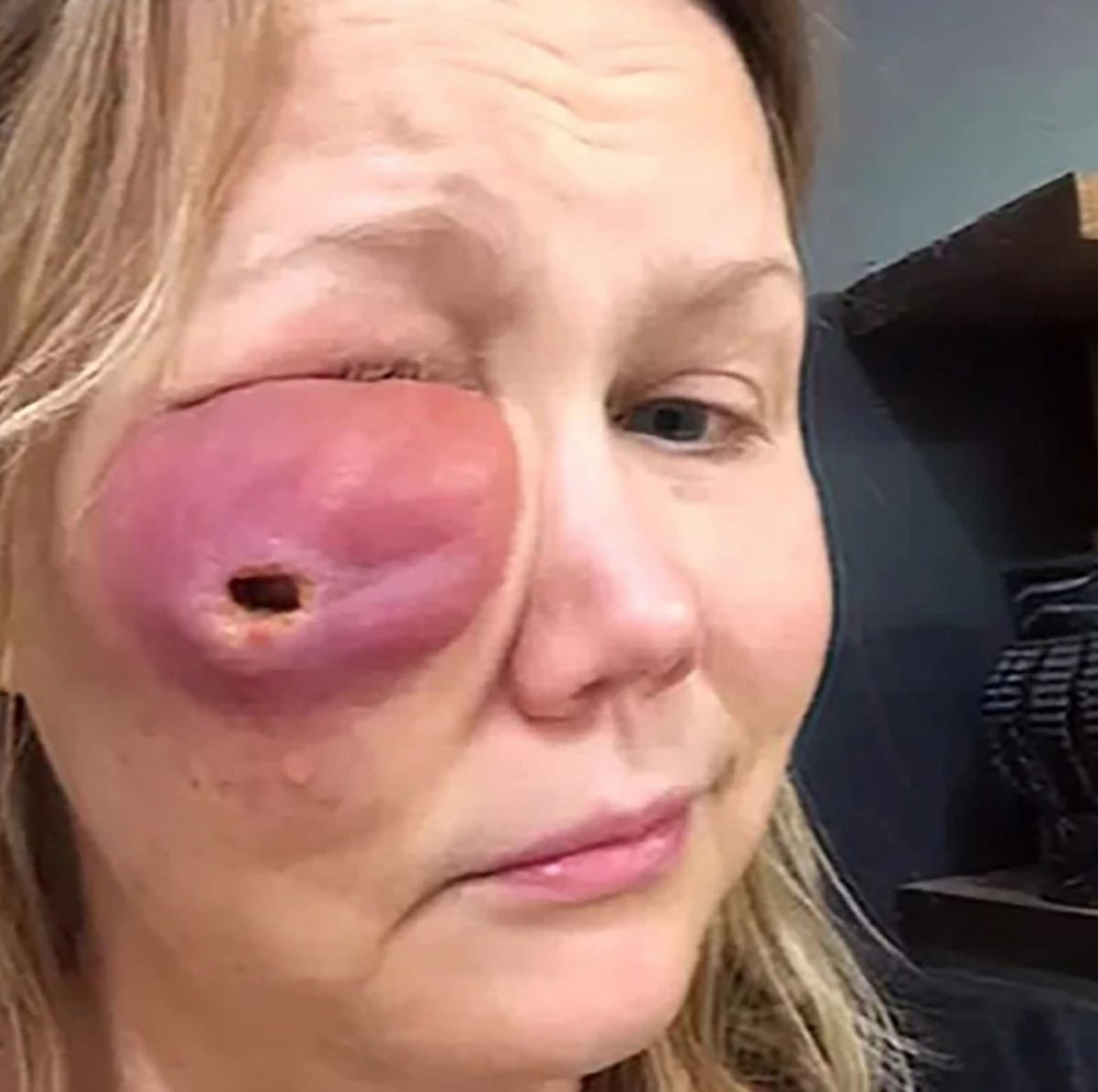 Woman Tries Cosmetic Fillers, Creates Massive Hole In Face Years Later