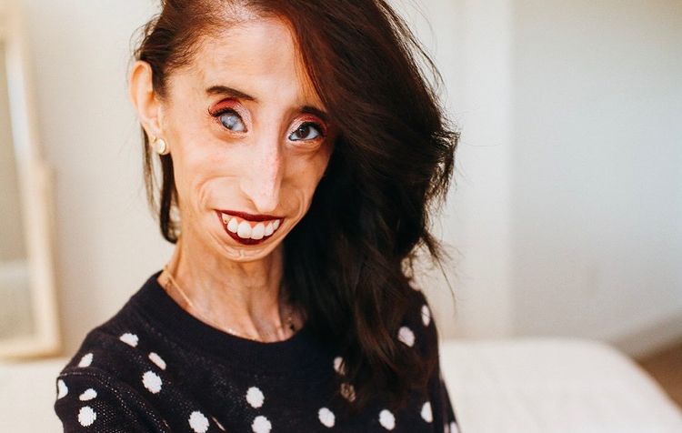 Who Is Lizzie Velasquez?