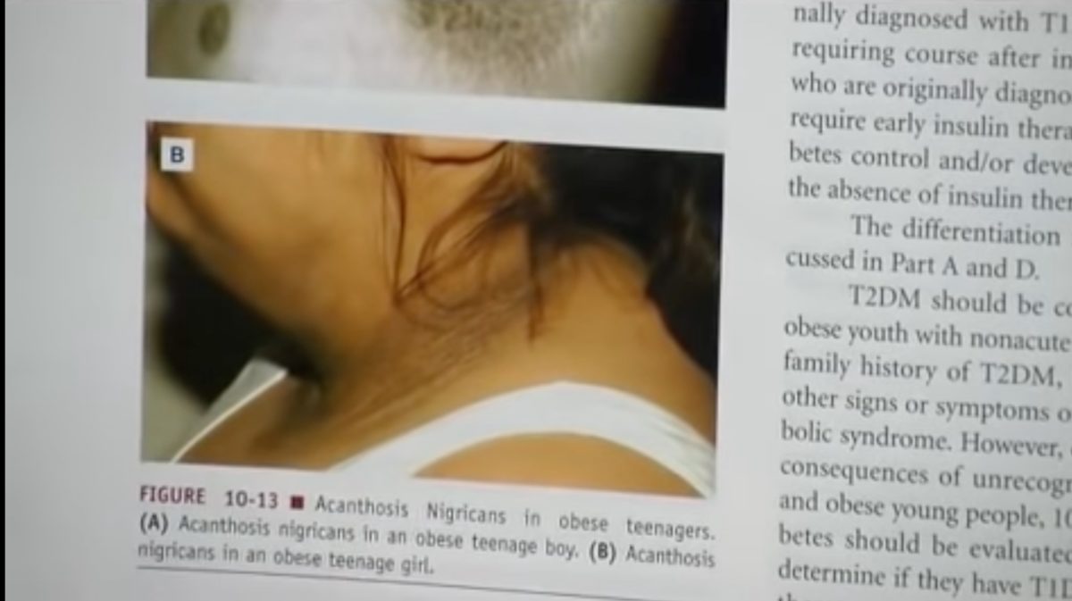 14-Year-Old Discovers Dark Ring Around Her Neck, Doctors Warn It's A Telltale Symptom Of This Disease | With obesity rates continuing to skyrocket among children in the past few years, so have cases of Type 2 diabetes among children and teens.